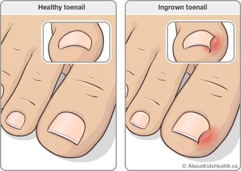 Toenail toe after ingrown surgery numb still What to
